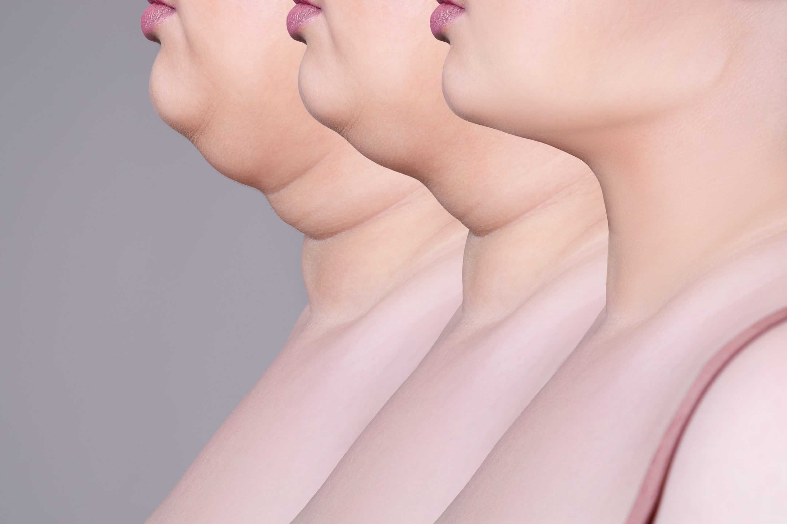 Kybella Treatment for Underneath Chin | Signature Aesthetics & IV Lounge | Liberty Hill, Tx